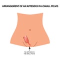 Arrangement of an appendix in a small pelvis. The appendix in the small pelvis. Infographics. Vector illustration