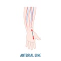 Arterial line catheter placed in the radial artery