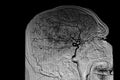 Arteriography brain image Royalty Free Stock Photo