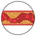 Cholesterol and atherosclerosis