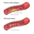 Arteriosclerotic vascular disease diagram science Royalty Free Stock Photo