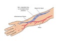 Arteriovenous fistula