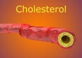 Artery with accumulation of cholesterol plaque isolated on gradient background with indicative text Royalty Free Stock Photo