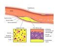 Artery atheroma plaque