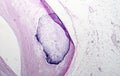 Artery calcification histopathology Royalty Free Stock Photo