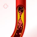 Artery with cholesterol buildup - cholesterol and thromb Royalty Free Stock Photo