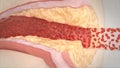 Artery Clogging with the Cholesterol Plaque