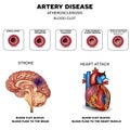 Artery disease, Atherosclerosis Royalty Free Stock Photo