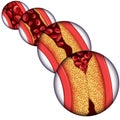 Artery Disease Diagram Royalty Free Stock Photo