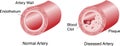 Artery with Plaque and Blood Clot