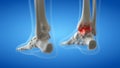 An arthritic ankle joint