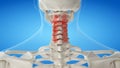 An arthritic cervical spine