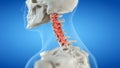 An arthritic cervical spine