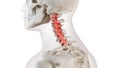 An arthritic cervical spine