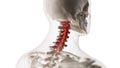 an arthritic cervical spine