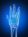 Arthritic hand Royalty Free Stock Photo