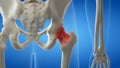 An arthritic hip joint
