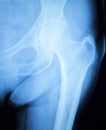 Arthritic hip xray test scan results Royalty Free Stock Photo