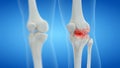 An arthritic human knee joint Royalty Free Stock Photo