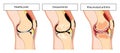 Arthritic knee joint