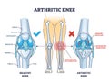 Arthritic knee or osteoarthritis and healthy bones comparison outline diagram