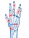 Arthritis Royalty Free Stock Photo