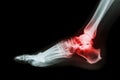 Arthritis at ankle joint (Gout , Rheumatoid arthritis) Royalty Free Stock Photo