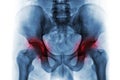Arthritis both hip . Film x-ray of human pelvis . Royalty Free Stock Photo