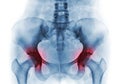 Arthritis both hip . Film x-ray of human pelvis Royalty Free Stock Photo