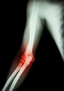 Arthritis at elbow Royalty Free Stock Photo