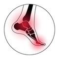 Arthritis foot concept Royalty Free Stock Photo