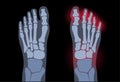 Arthritis foot concept