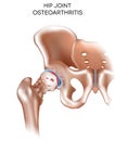 Arthritis of the hip joint Royalty Free Stock Photo