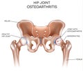 Arthritis of the hip joint Royalty Free Stock Photo