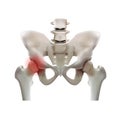 Arthritis of the hip joint on a white background. Illustration Royalty Free Stock Photo