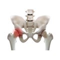Arthritis of the hip joint on a white background Royalty Free Stock Photo
