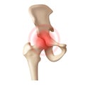 Arthritis of the hip joint on a white background Royalty Free Stock Photo