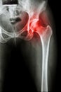 Arthritis at hip joint Royalty Free Stock Photo