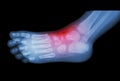 Arthritis and injury at ankle : film x-ray of child's foot ( side view ) ( lateral )