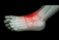 Arthritis and injury at ankle : film x-ray of child's foot ( side view ) ( lateral )