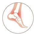Arthritis foot concept Royalty Free Stock Photo