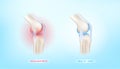 Arthritis knee joint in leg and bone healthy. Human bone anatomy damage treatment osteoarthritis.