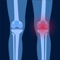 Arthritis in knee joint Royalty Free Stock Photo