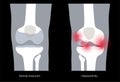 Arthritis in knee joint