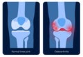 Arthritis in knee joint