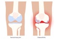 Arthritis in knee joint