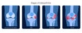 Arthritis in knee joint