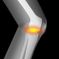 Arthritis in knee, pain of knee, suffering from knee