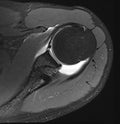 ARTHROGRAM MRI WITH CONTRAST