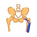 Arthroplasty flat color icon. Hip replacement implant installed in the pelvis bone. Sign for web page, mobile app, button, logo.